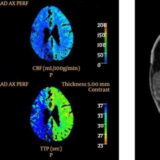 A companion case. CT perfusion in a patient under stroke code shows... | Download Scientific Diagram