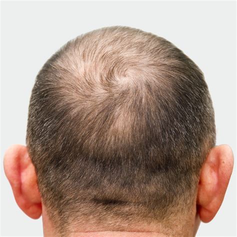 Crown Hair Thinning Identify And Stop It With These Steps