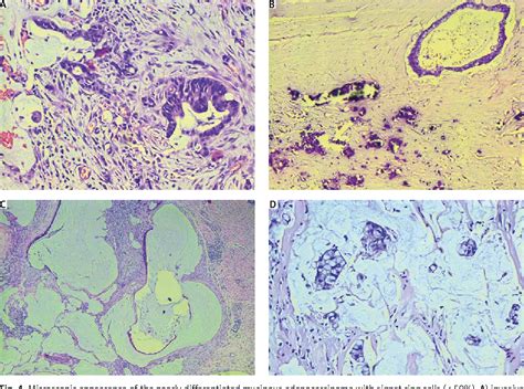 Figure 4 From Pseudomyxoma Peritonei Of Appendiceal Origin Mimicking