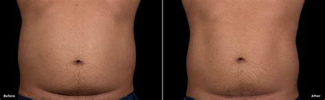 TruBody TruSculpt Flex TruSculpt ID Body Contouring Washington DC