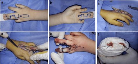 A Dorsal View Of A Left Complete Syndactyly With Preoperative Markings