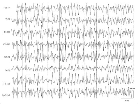 Eeg Recording During Slow Sleep Shows Diffuse Continuous Spike Waves