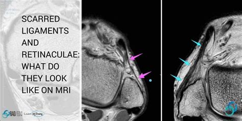 MRI RETINACULA SCAR: SCARRED LIGAMENTS AND RETINACULA: WHAT DOES MRI SCAR TISSUE LOOK LIKE ...