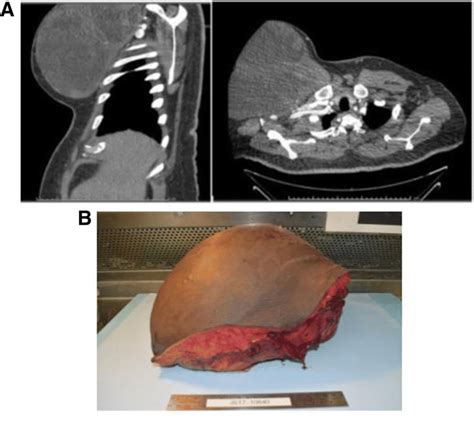 A Preoperative Ct Chest B En Bloc Resection Chest Wall Sarcoma