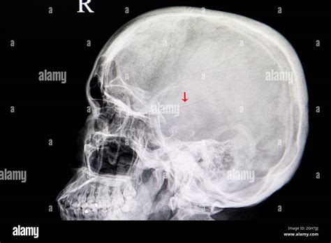 Head Trauma Skull Fracture Hi Res Stock Photography And Images Alamy