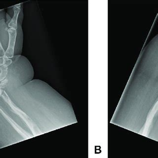 Radiographs At Weeks A Anteroposterior And B Lateral Plain