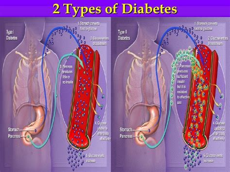 Endocrine System And Diabetes Mellitus Diabeteswalls