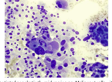 Anaplastic Thyroid Cancer Cytology Cancerwalls