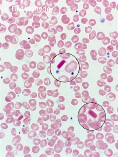 Sickle Cell Disease Hemoglobin C Hemoglobinopathy Hemoglobin Hot Sex