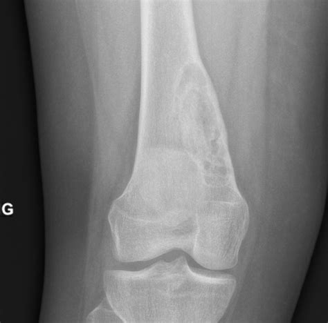 Non Ossifying Fibroma Radiology Case