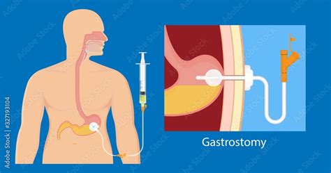 Peg Gastric Nasojejunal Orogastric Inserted Nasoduodenal