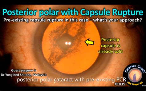 1839: posterior polar with capsule rupture – Cataract Coach™