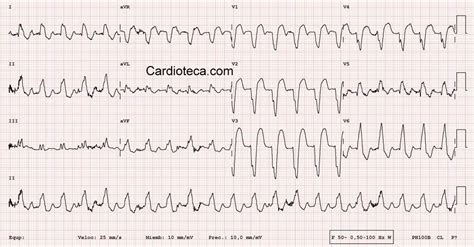 Curso ECG Taquicardia Regular QRS Ancho