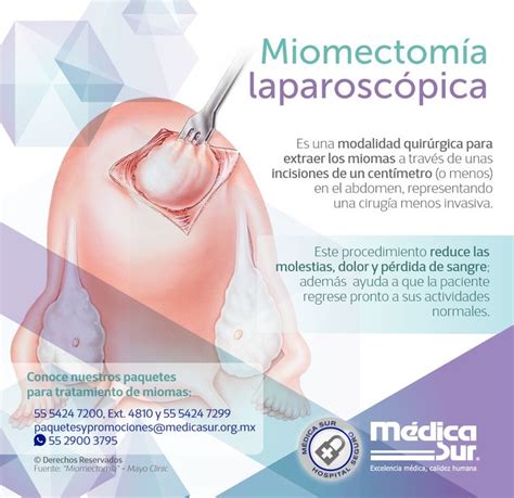 Miomectomía laparoscópica Miomas uterinos Uterina Quirúrgica