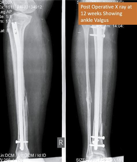 Extra Articular Distal Tibial Fractures Is Interlocking Nailing An