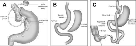 Bariatric Surgery Advances In Pediatrics