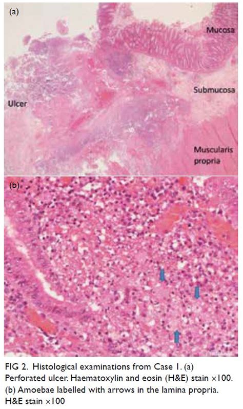 Entamoeba Histolytica Flask Shaped Ulcers