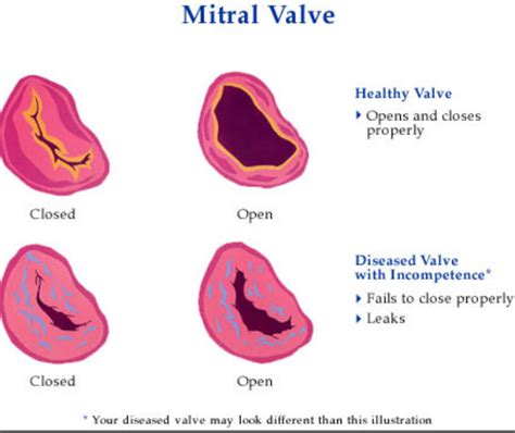 Mitral Valve Rheumatic Fever Mitral Valve