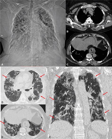 Figure 1 From Imaging Approach To Pulmonary Infections In The Immunocompromised Patient