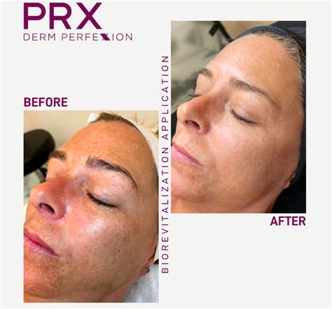 Prx Derm Perfection Chelmsford Ma Begin With Skin Med Spa Medical Spa