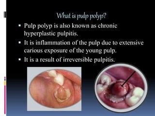 Pulp polyp and gingival polyp | PPT