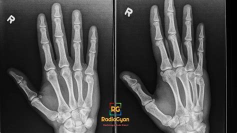 Boxer’s Fracture [Why is it A Misnomer?] | Radiology Case | - RadioGyan