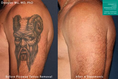 Top More Than 58 Tattoo Removal Methods In Cdgdbentre