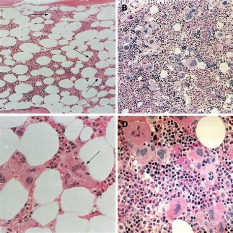 Bone Marrow Histology In Jak2 Exon 12 Polycythemia Vera Download