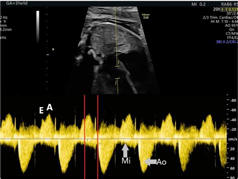 Jcm Free Full Text Treatment Of Fetal Arrhythmias