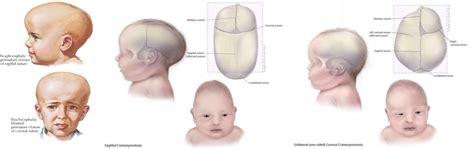 Craniosynostosis Dr Prem Pillay