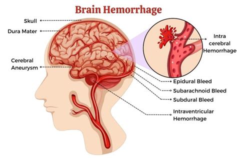 Types Of Brain Hemorrhage