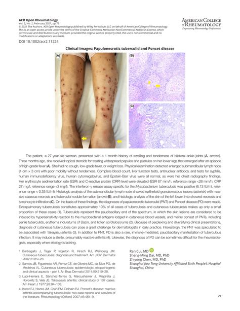 Pdf Clinical Images Papulonecrotic Tuberculid And Poncet Disease