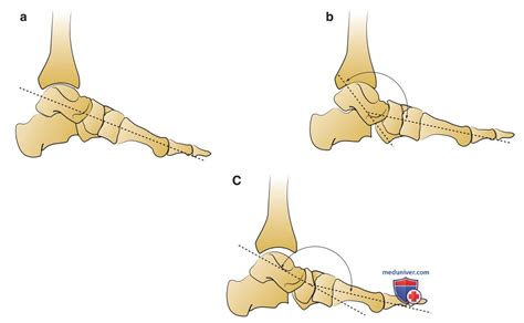 Причины уплощение продольного медиального свода стопы ребенка и тактика ...
