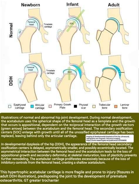 Dr Omid Bandarchi M D On Twitter For Infants Mos Pelvis