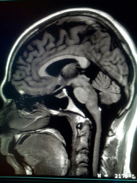 Radiodiagnóstico RMN Cerebral MAV