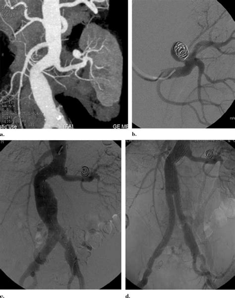 Endovascular Treatment Of Visceral And Renal Artery Aneurysms Journal Of Vascular And