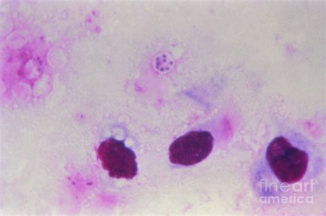 Pneumocystis Jirovecii In Lung Lm 1 By Science Source