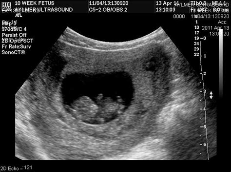 Pelvic Ultrasound: Complete Pelvic Ultrasound