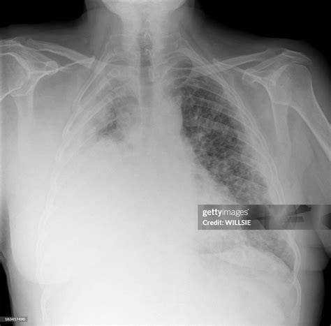 Extensive Right Mesothelioma On A Chest Xray From Asbestos Exposure ...