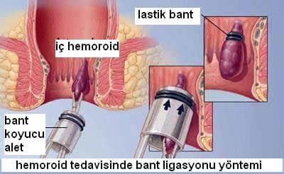 Hemoroid Basur Nedir Belirtileri Nedenleri Ve Tedavisi