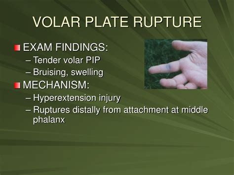 Ppt Hand And Wrist Injuries Powerpoint Presentation Free Download Id4108470