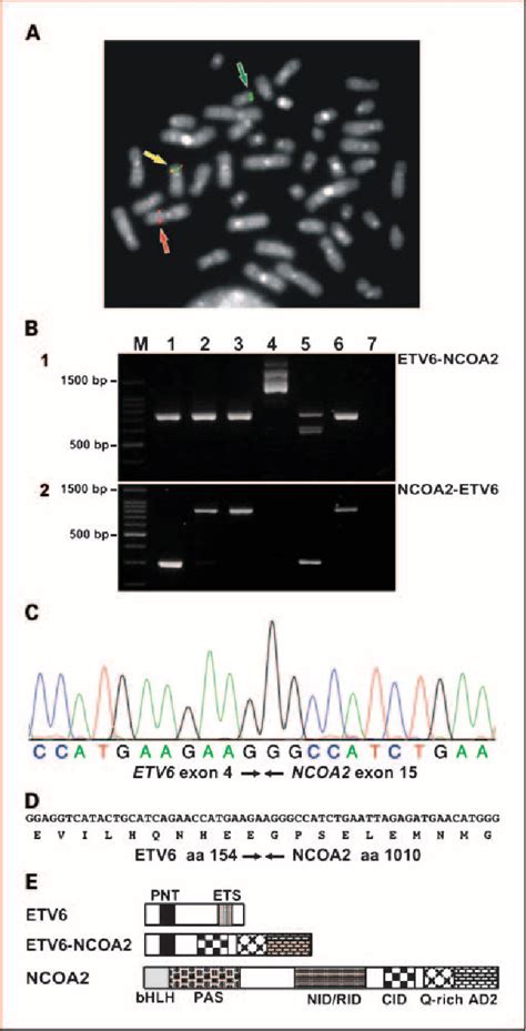 PDF ETV 6 NCOA 2 A Novel Fusion Gene In Acute Leukemia Associated