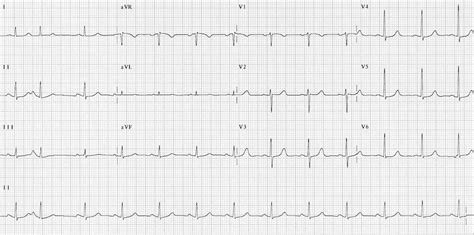 Preexcitation Syndromes Litfl Ecg Library Diagnosis