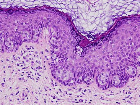 Paget's Disease of the Breast and Extramammary Paget's Disease