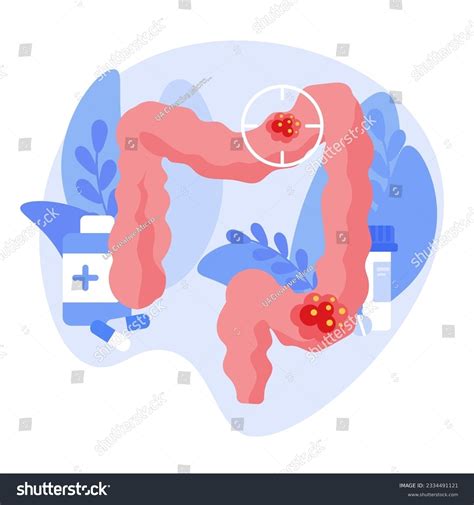 大腸炎 イラスト3084点を超えるロイヤリティフリーでライセンス可能なイラスト素材とスケッチ Shutterstock