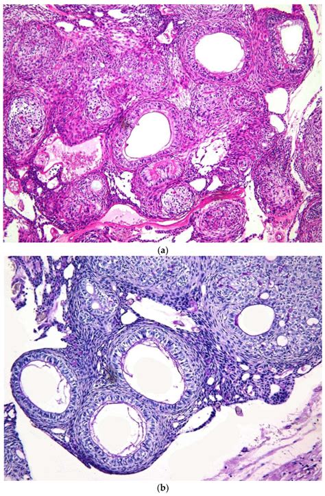 Clinico Pathological Presentations Of Cystic And Classic Adenomatoid