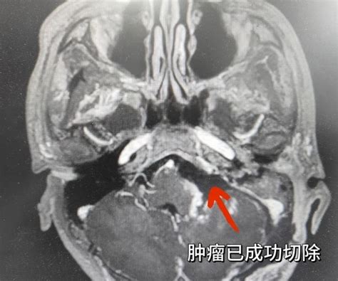 贵阳市第二人民医院成功完成了一例罕见巨大型听神经瘤手术腾讯新闻