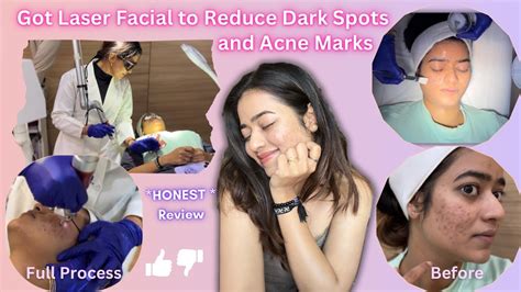 Got Laser Facial To Reduce Dark Spots And Acne Marks Honest Review