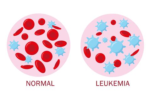 Normal Blood And Leukemia Blood For Medical Concept Blood Analysis Or