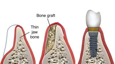 Bone-graft-dental-implant-2 - Pacific Oral Surgery